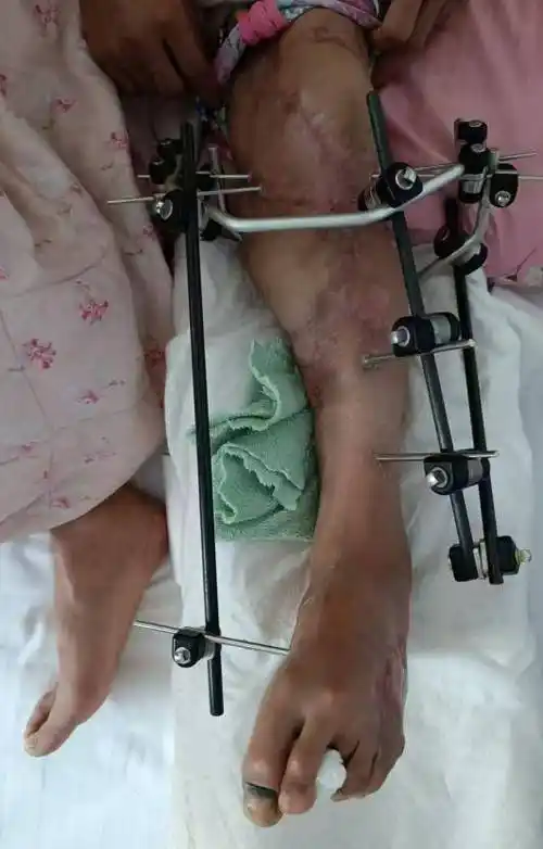 路】截肢边缘患者重获新生 医生妙手回春创造希望_田主任_手术_田小宁