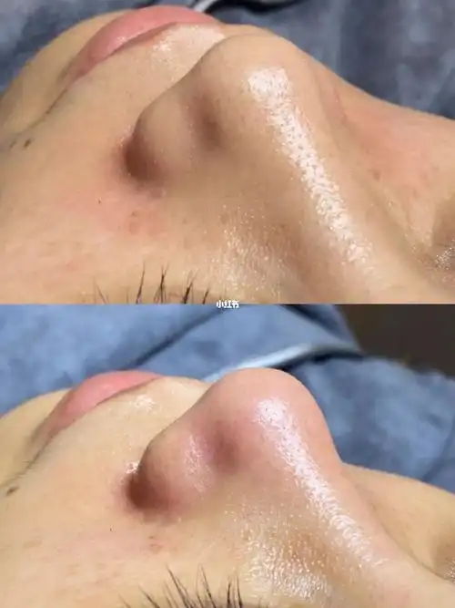 障碍989969♀15#毛孔清洁#黑头#黑头粉刺#收缩毛孔#针清闭口