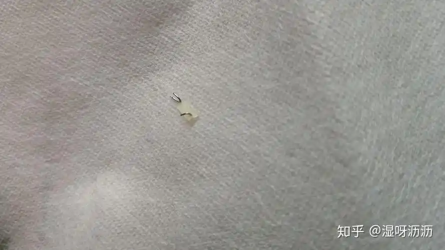 包皮钛钉20天手动去钛钉