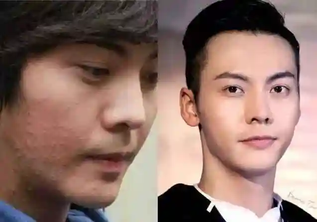 王俊凯素颜满脸痘痘太吓人!医生为你的战"痘"支招!