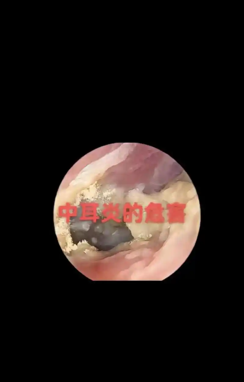 真菌性中耳炎是一种常见的耳道疾病,随着生活的节奏加快,压力大 - 抖