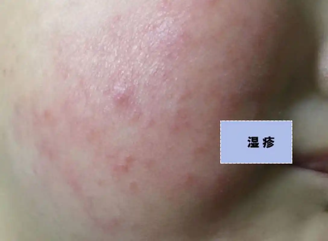 孩子身上长了一些红籽籽,是湿疹还是痱子,家长该如何区别?