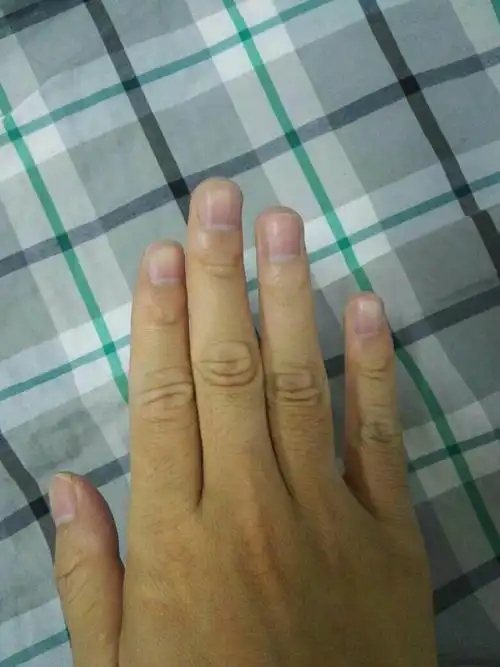 十个手指甲发紫怎么回事?