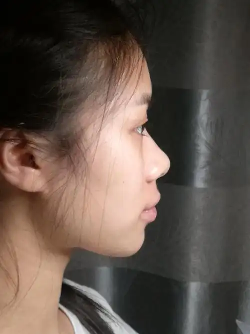 各位刘亦菲们 来帮俺看看这侧脸到底还可以挽救一下吗