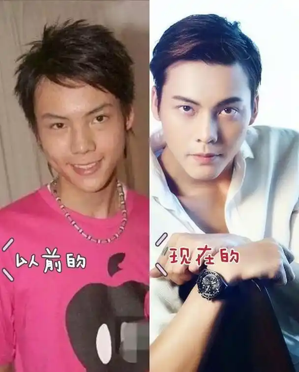 现在的陈伟霆,鼻头越变越小,山根也变高了,因为整容得当,不留痕迹,陈