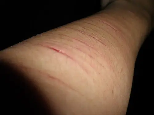 手被割伤3毫米左右 请问有没有割到静脉