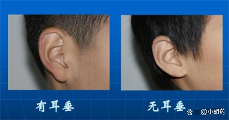 "穷人耳","富人耳",是什么原因导致了耳朵形态各异呢?