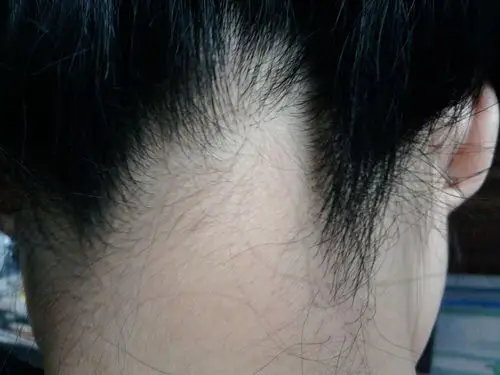 后面的发际线高低不平,特别是头发扎高了就觉得难看,可能是小时候头发