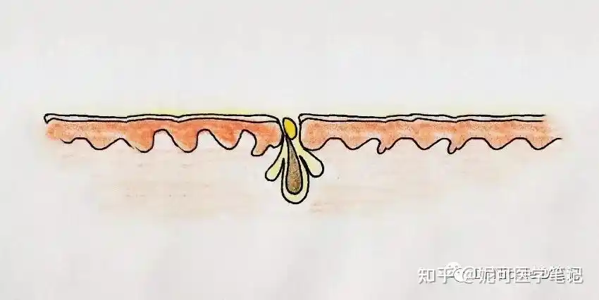 学习分享105黑头粉刺是怎么形成的