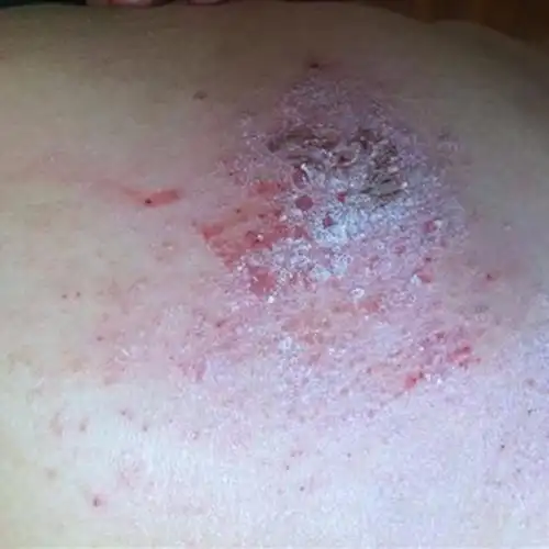 宝宝肛门湿疹瘙痒的图片_有来医生