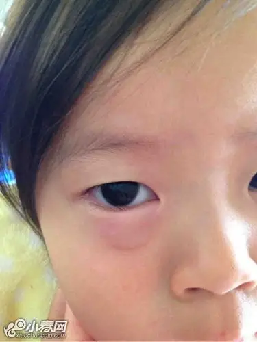 急问,闺女眼睑上起了水泡