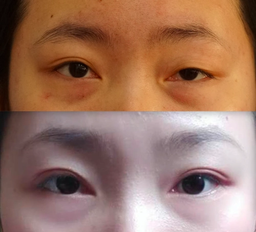 先天性上睑下垂患者我为什么建议在成年后再进行手术?