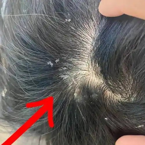 其中最常见的是脂溢性皮炎和头皮真菌感染