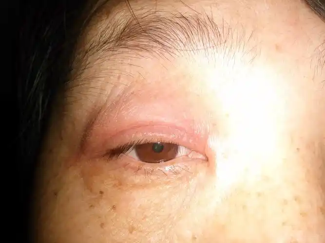 【眼眶病讨论】女 50岁 眼睛上皮【红肿痒】 [病例帖]