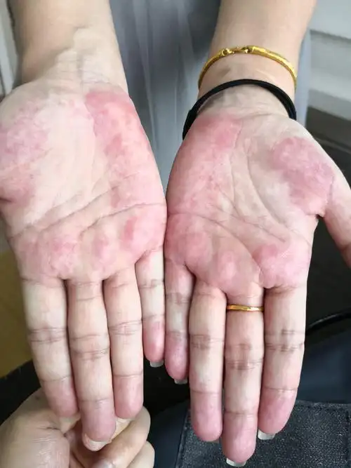 [皮肤病] 双手掌这是什么病