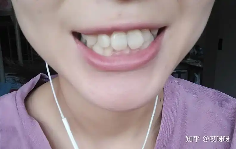 正畸分享虎牙埋伏牙