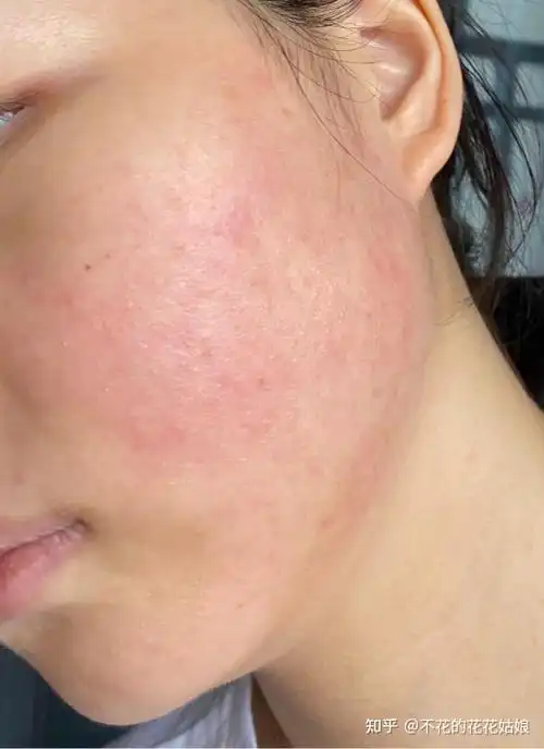 那个陆十六神经酰胺凝露对皮肤泛红真的有用嘛? - 知乎