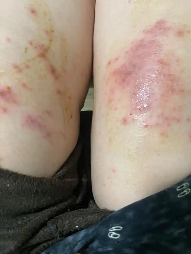 得了新冠后引发的的皮炎湿疹