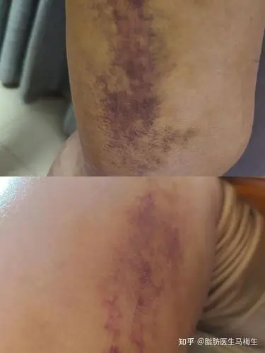 (吸脂术后皮肤淤青)▲除了上述后遗症,还有其他严重如皮肤坏死,皮肤