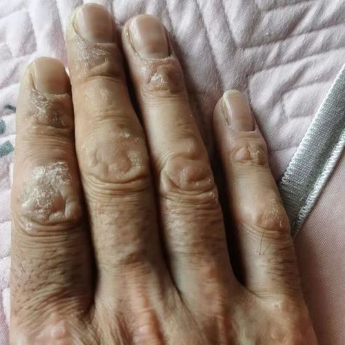 手指关节癣真菌手指关节长硬疙瘩伤癣脱皮干裂手癣真菌感染干裂 2鎹1
