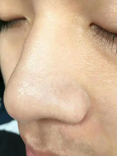 男生毛孔粗大原因