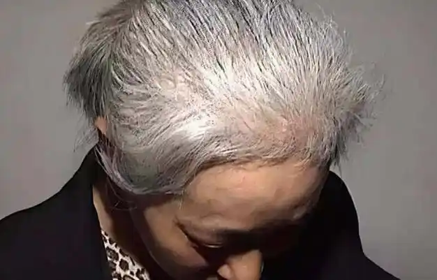 特征①头发稀疏一,中年女人容易加重老气的"5"个特征,看看你有没有?