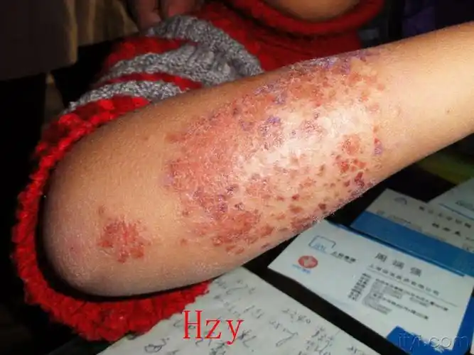 看这小儿的皮损----------湿疹 - 皮肤及性传播疾病讨论版 - 爱爱医