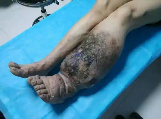 下肢橡皮腿样肿涨感治疗后消失 - 好大夫在线