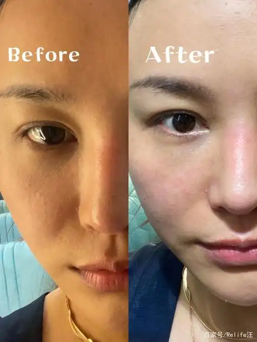 水光针搭配什么打效果比较好?