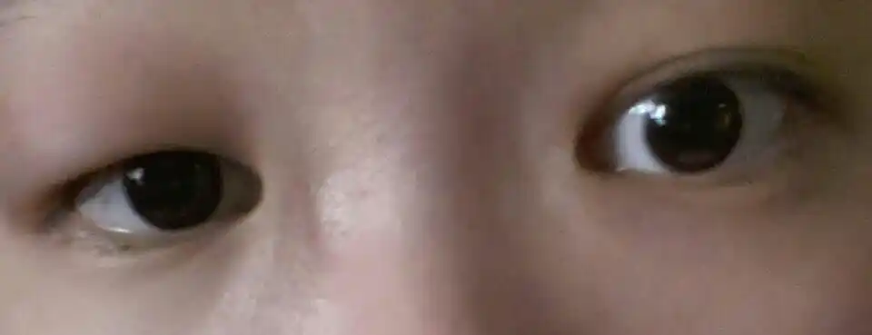 早上醒来眼睛肿起来是什么回事?看东西会蒙蒙的.