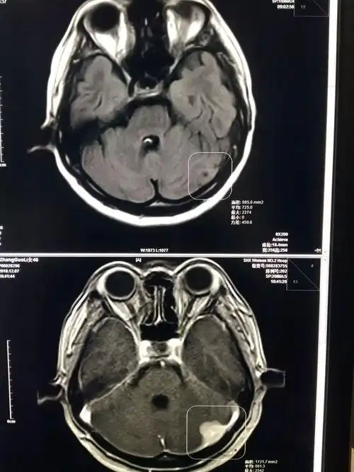 通过ct平扫和核磁t2及flair像,均发现病灶显示不是很明显,容易造成漏