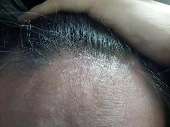 头皮屑非常多,就算是刚刚洗完头,干了之后抓一抓也是,大把大把掉