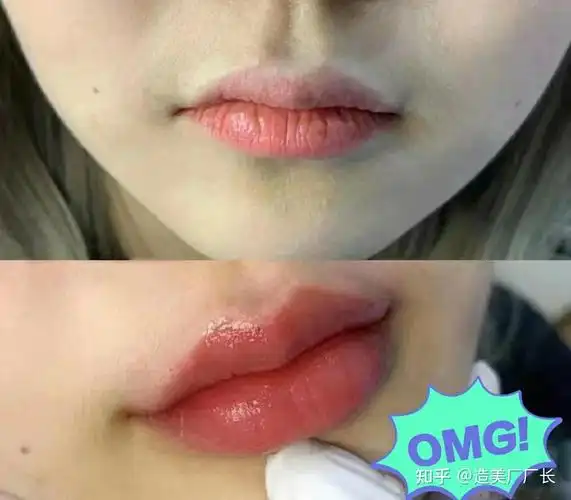 做个嘟嘟唇丰唇需要多少钱