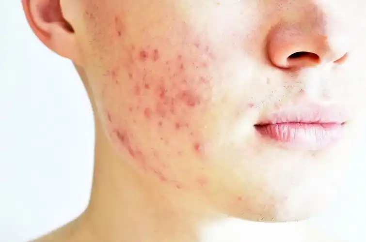 严重痘痘脸图片_39健康网_精编内容