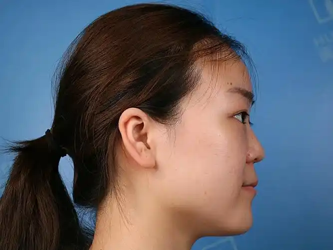 鼻女生扁平鼻子图片越扁平鼻子扁平凹陷脸侧面扁平女生图片照凹陷侧面