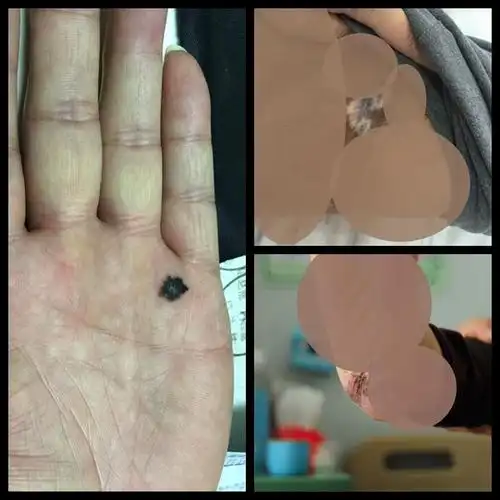 这就是发生癌变的色素痣.