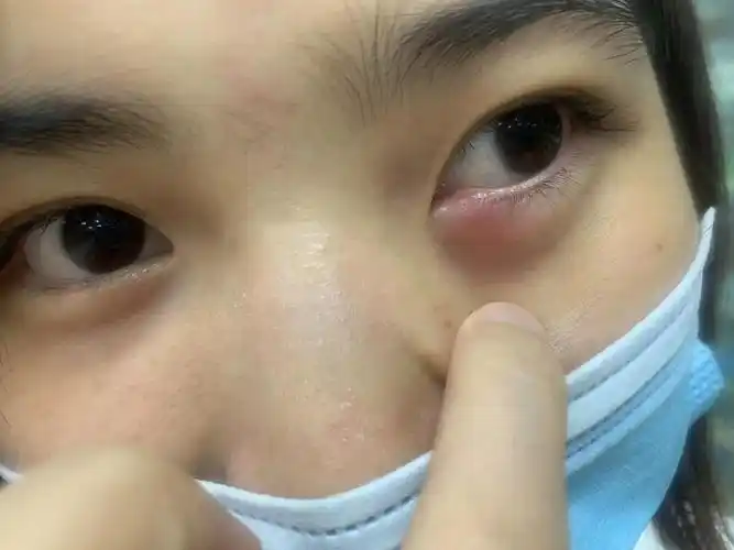 去看了医生,怎么也没想到是上火了,这玩意还能上火到眼睛也是第一次