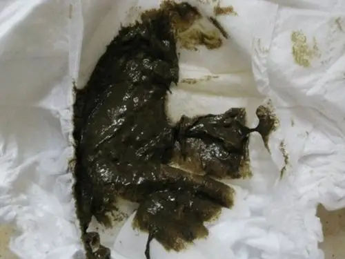 胃癌黑大便图片 (23)