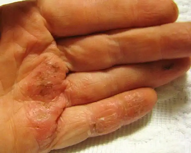 一期梅毒图片——肛门部硬下疳图片_有来医生