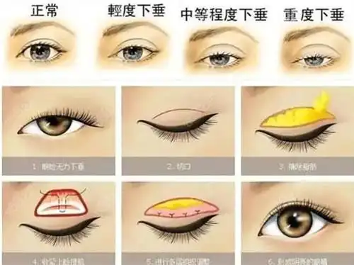 上睑提肌你必须知道这些,眼睑下垂矫正-8682赴韩整形网