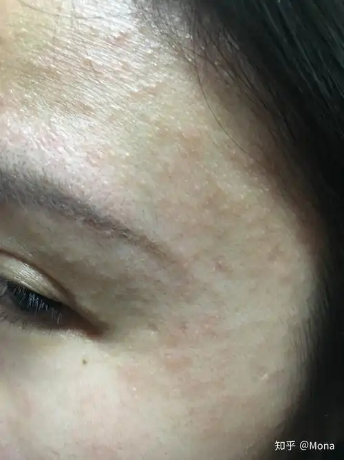 雅诗兰黛小棕瓶使用后过敏,有同样经验的请分享? - 知乎