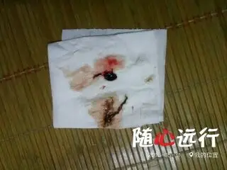 我昨天下午上厕所突然发现白带有血丝,去医院检查bc正常,医生说没事