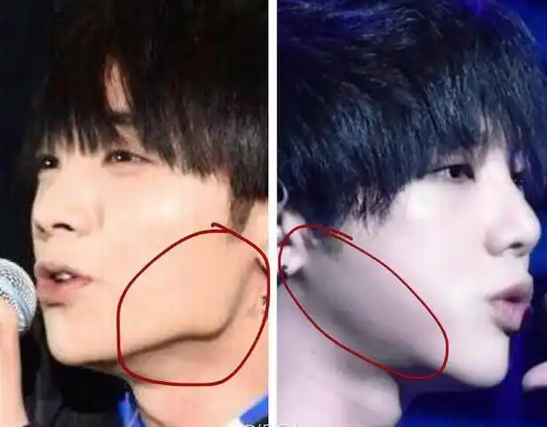 华晨宇整容前后照片华晨宇做了下颌角整形