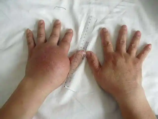 肺癌手掌骨转移的粒子刀治疗 - 好大夫在线