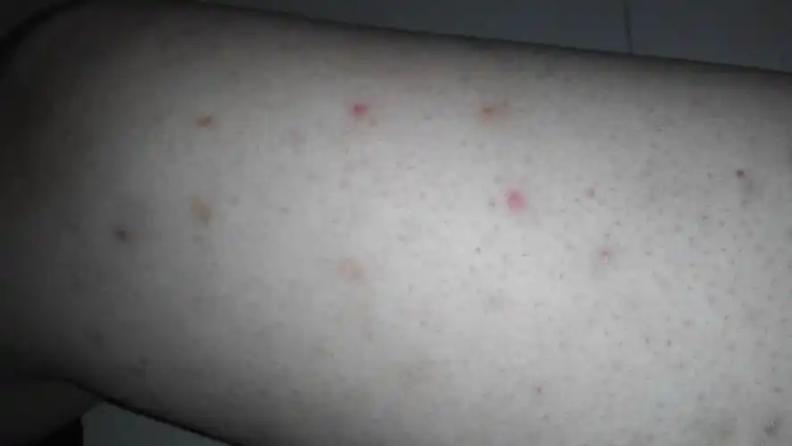 大腿上的小红点,不疼不痒,好久了,是否是毛孔粗大,还是?如何