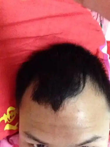 额头两边掉发怎么办啊.555.25岁就要秃顶了吗