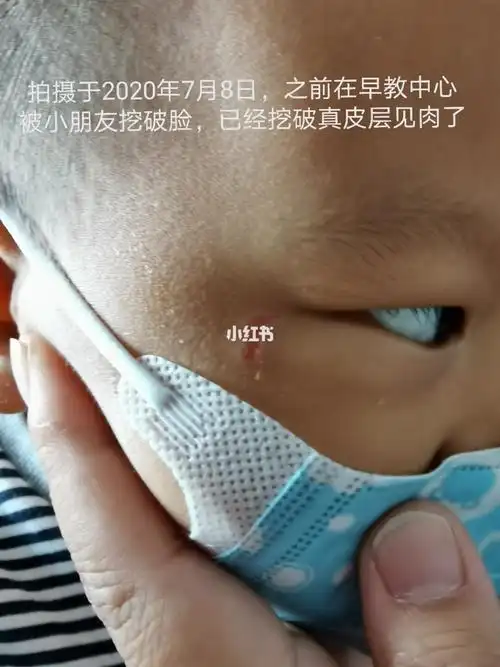 小儿子真皮层破损修复!