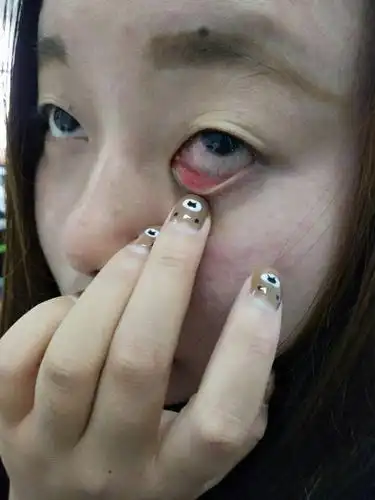 寻找眼科医生,我眼睛成了角膜溃疡,有谁知道怎么办?