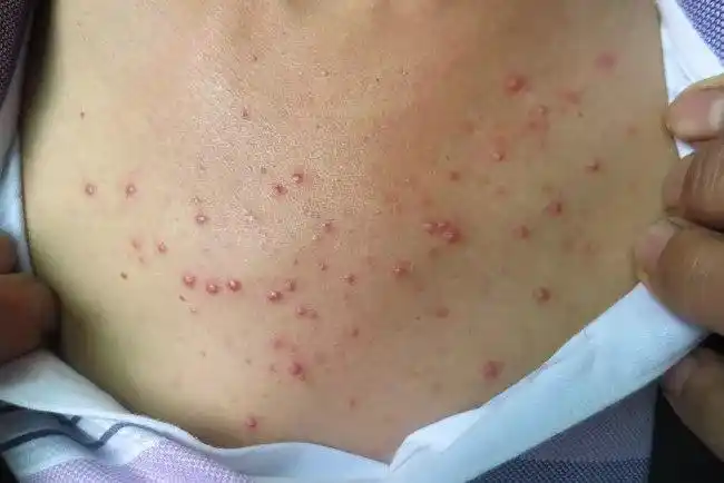 毛囊炎的早期症状图片