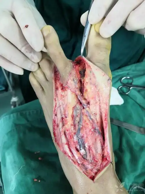 【讨论】足趾移植再造示指 [精华] [病例帖]